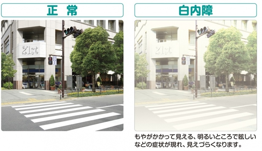 白内障セルフチェック|当てはまる項目がある方は早めに眼科へ