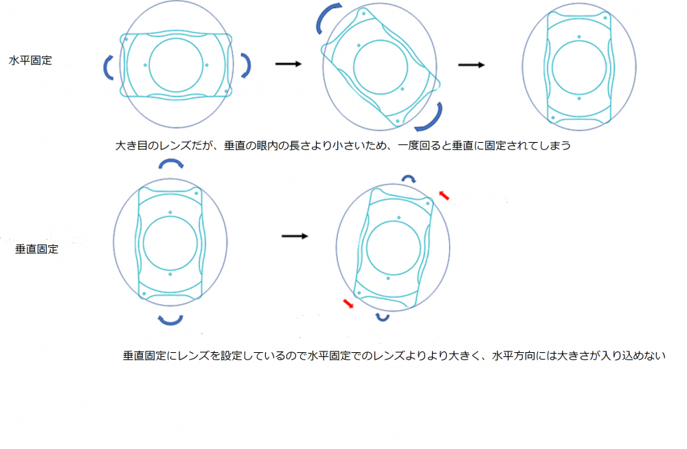 垂直固定は、ICL(眼内コンタクト)が安定しやすい理由
