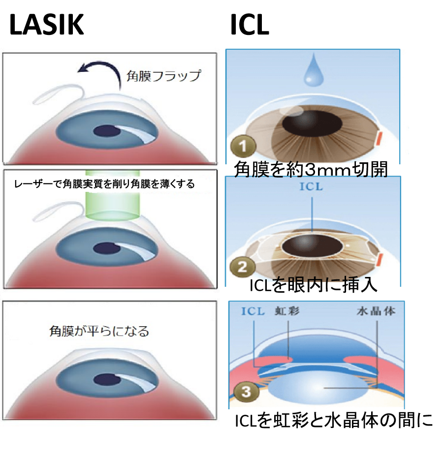 術式の考え方の違い|レーシックとICLは何が違う?